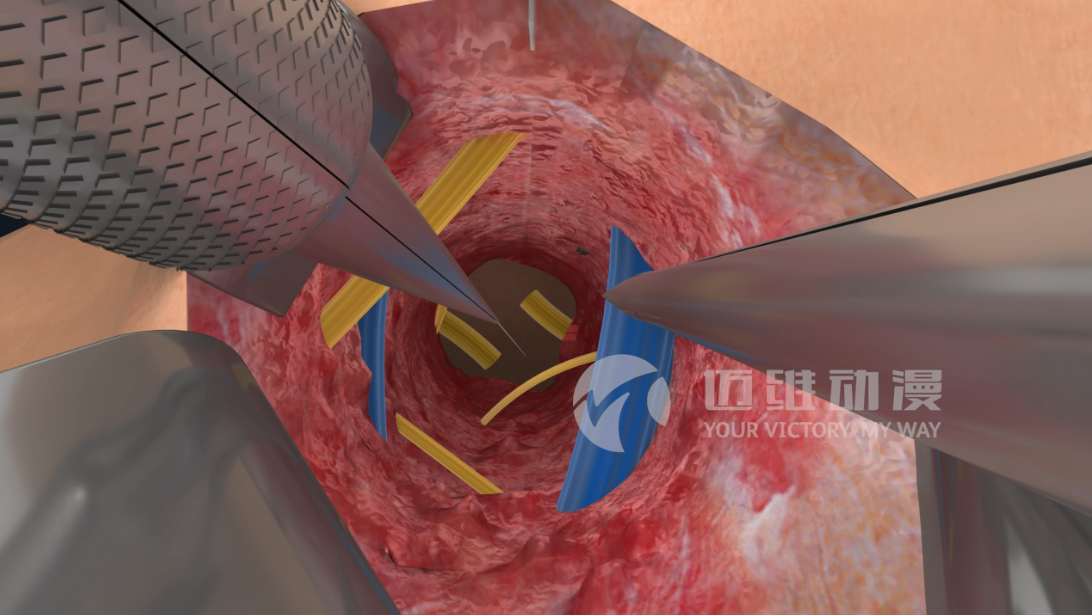 醫學(xué)手術(shù)三維動(dòng)畫(huà)